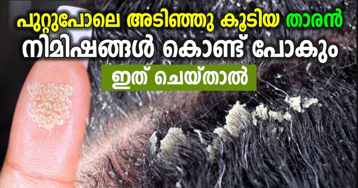 Remove Dandruff Tips